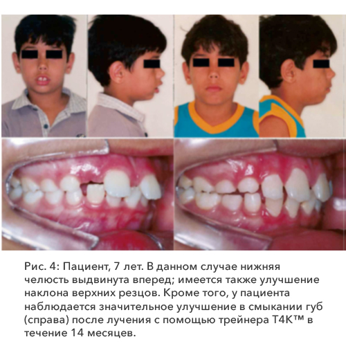 Рис. 4: Пациент, 7 лет. 