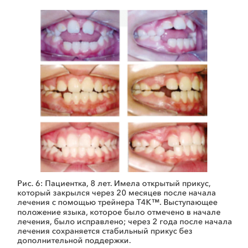Рис. 6: Пациентка, 8 лет. 