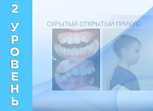 Лечение открытого прикуса