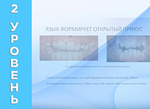 Миофункциональное лечение дистального прикуса